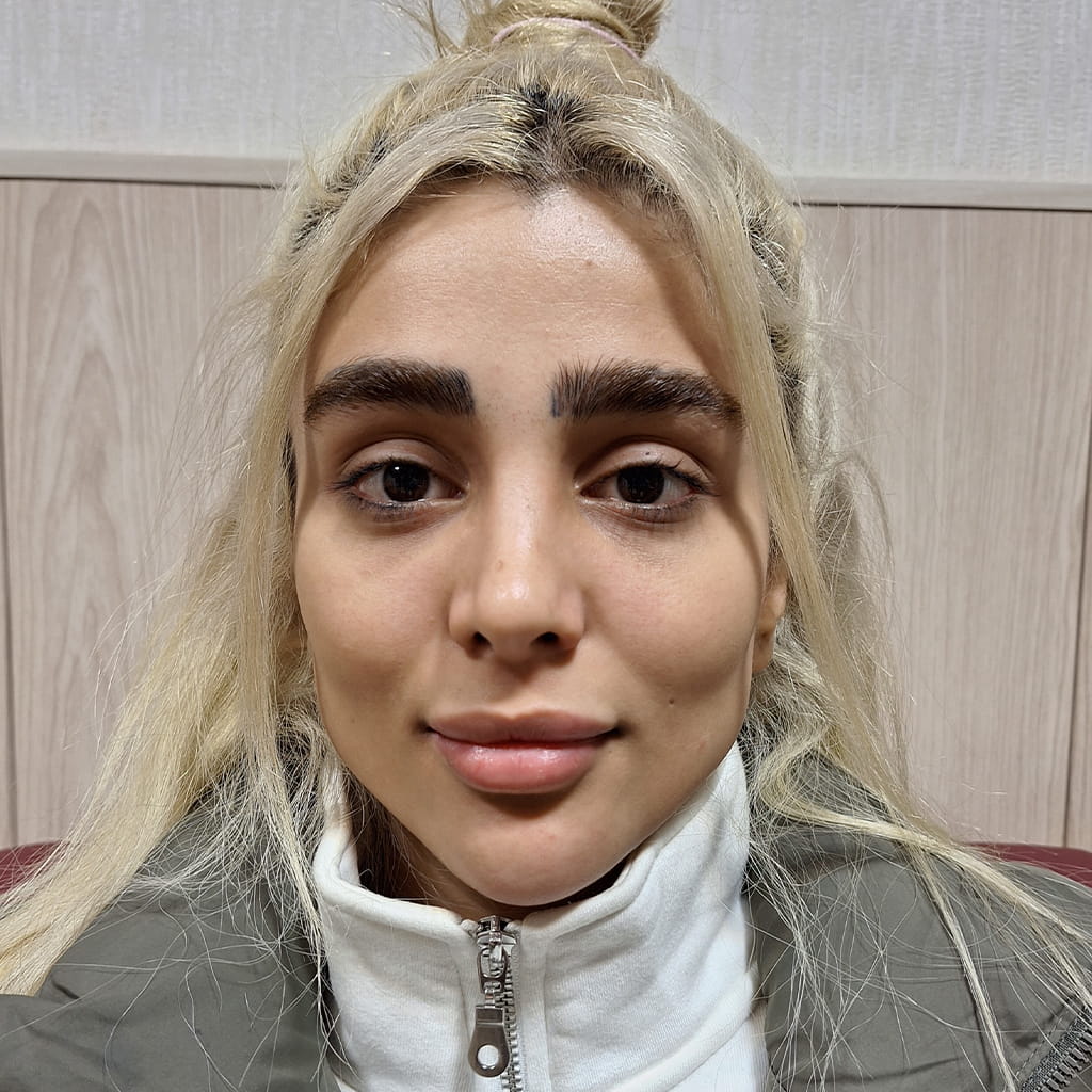 قبل الإجراء — عيون بنية داكنة