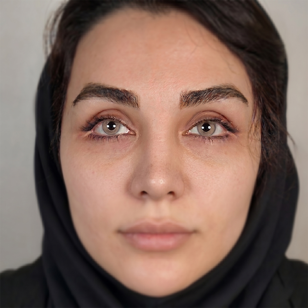 بعد عملية تصبغ القرنية — نتيجة رمادي ذهبي للعين، إيران