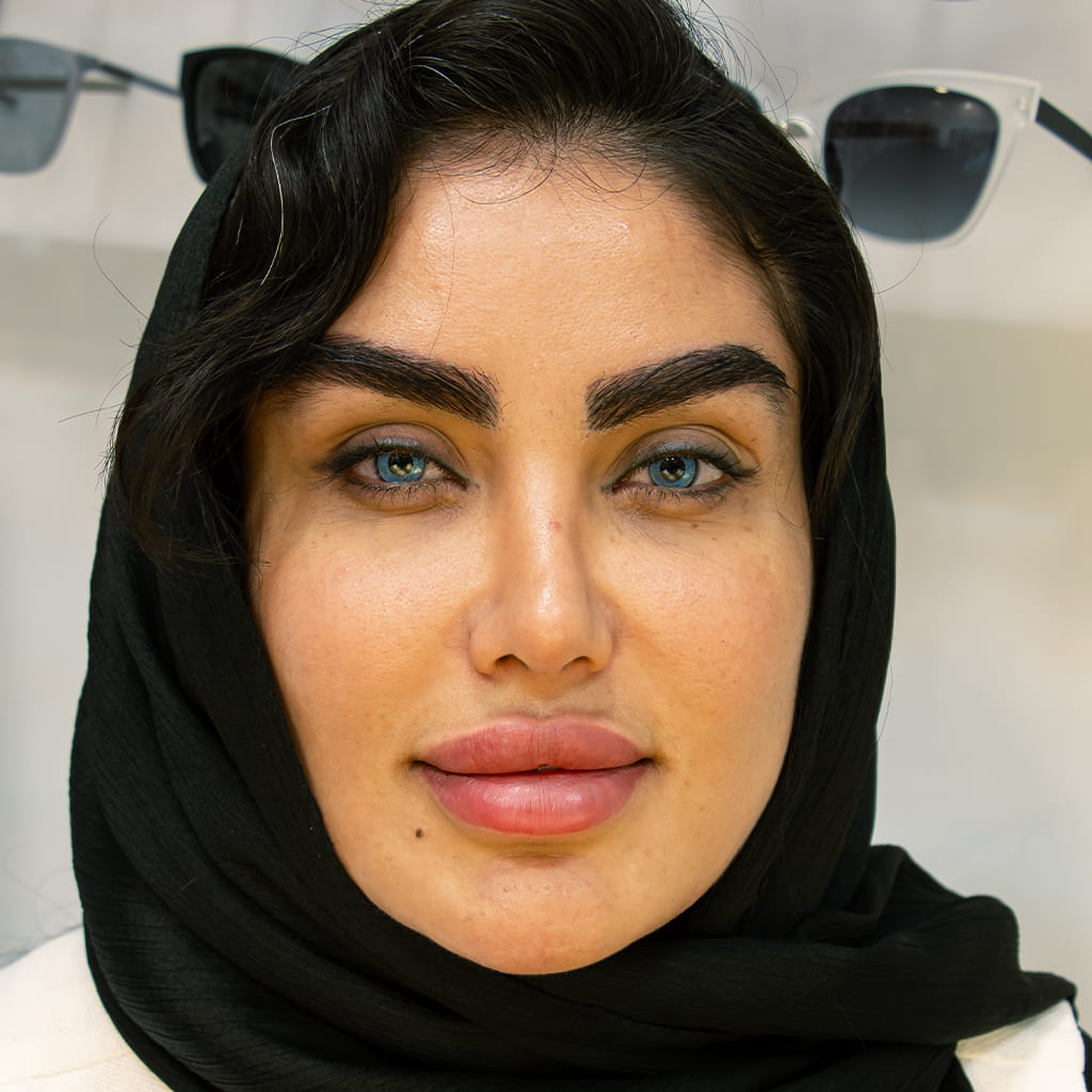 بعد عملية تصبغ القرنية — لون فرنسوي أزرق للعين، إيران