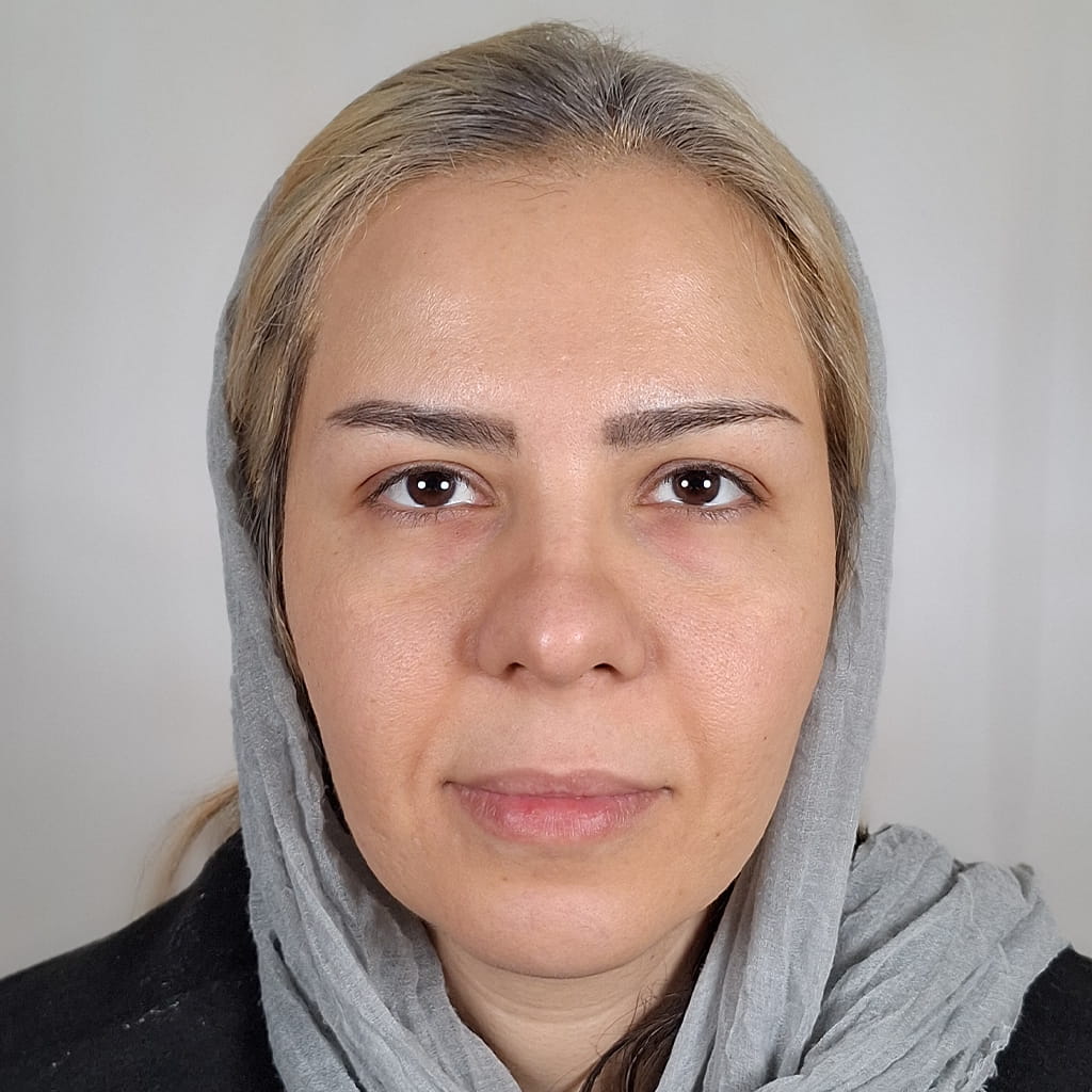 صورة قبل تغيير لون العين بتقنية صبغ القرنية الدائمة في مركز كروماتيك آيز بإيران