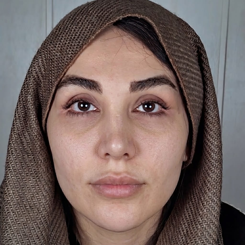 صورة قبل تغيير لون العين بتقنية صبغ القرنية في مركز كروماتيك إيران — عيون بنية داكنة قبل الإجراء