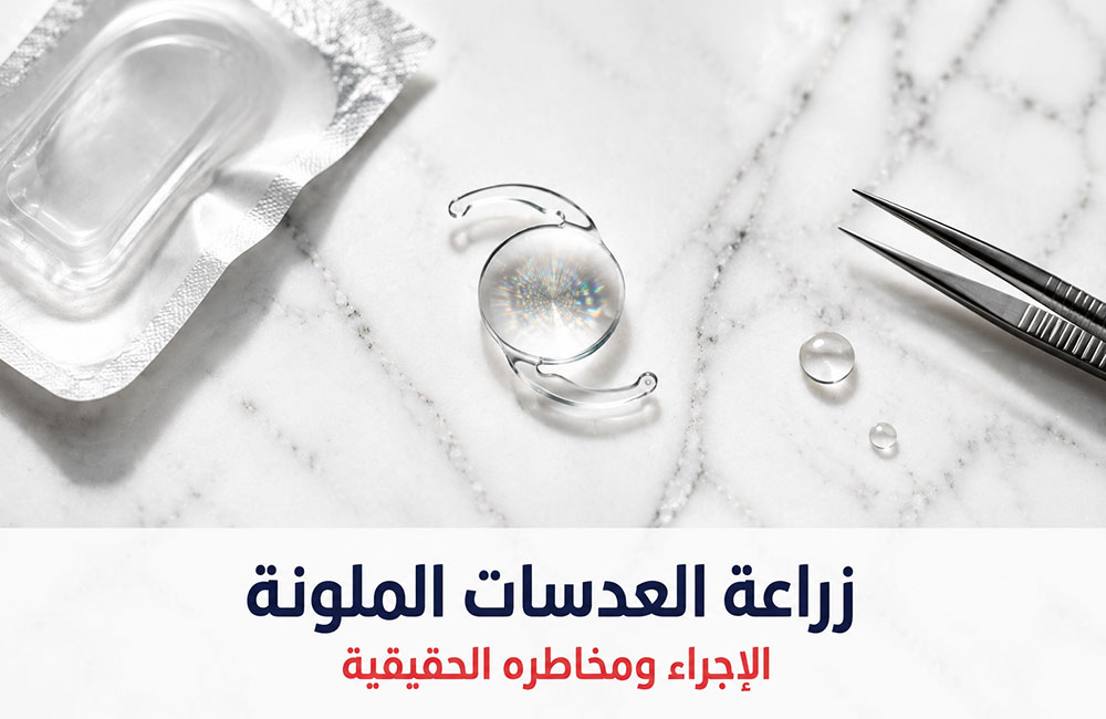 زراعة العدسات الملونة (القزحية الاصطناعية). الإجراء ومخاطره الحقيقية