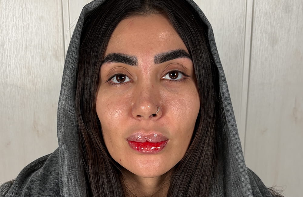 مريضة إيرانية بعيون بنية طبيعية قبل تغيير لون العيون بزراعة الصباغ القرنية في مركز عيون كروماتيك الطبي