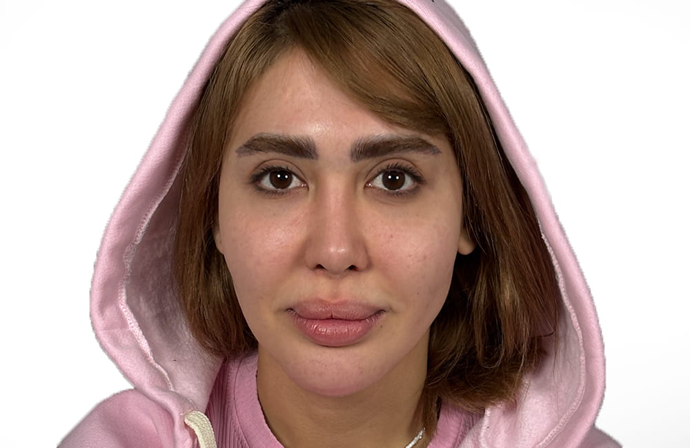 مريضة إيرانية بعيون بنية طبيعية قبل تغيير لون العيون بزراعة الصباغ القرنية في مركز عيون كروماتيك الطبي