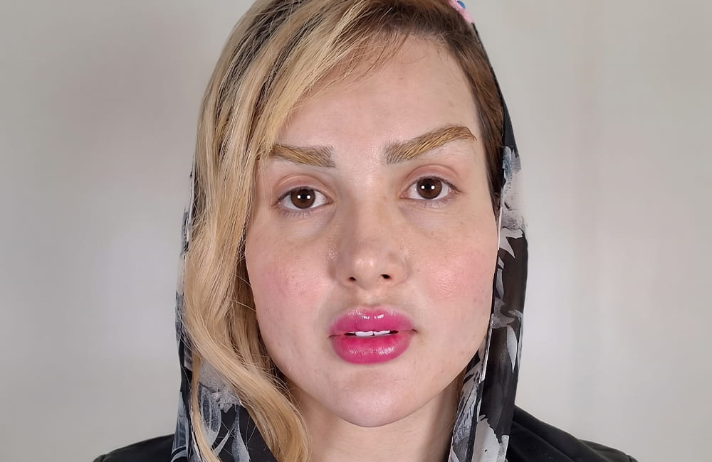 مريضة إيرانية بعيون بنية طبيعية قبل تغيير لون العيون بزراعة الصباغ القرنية في مركز عيون كروماتيك الطبي