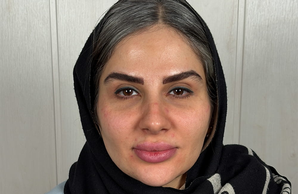مريضة إيرانية بعيون بنية طبيعية قبل تغيير لون العيون بزراعة الصباغ القرنية في مركز عيون كروماتيك الطبي