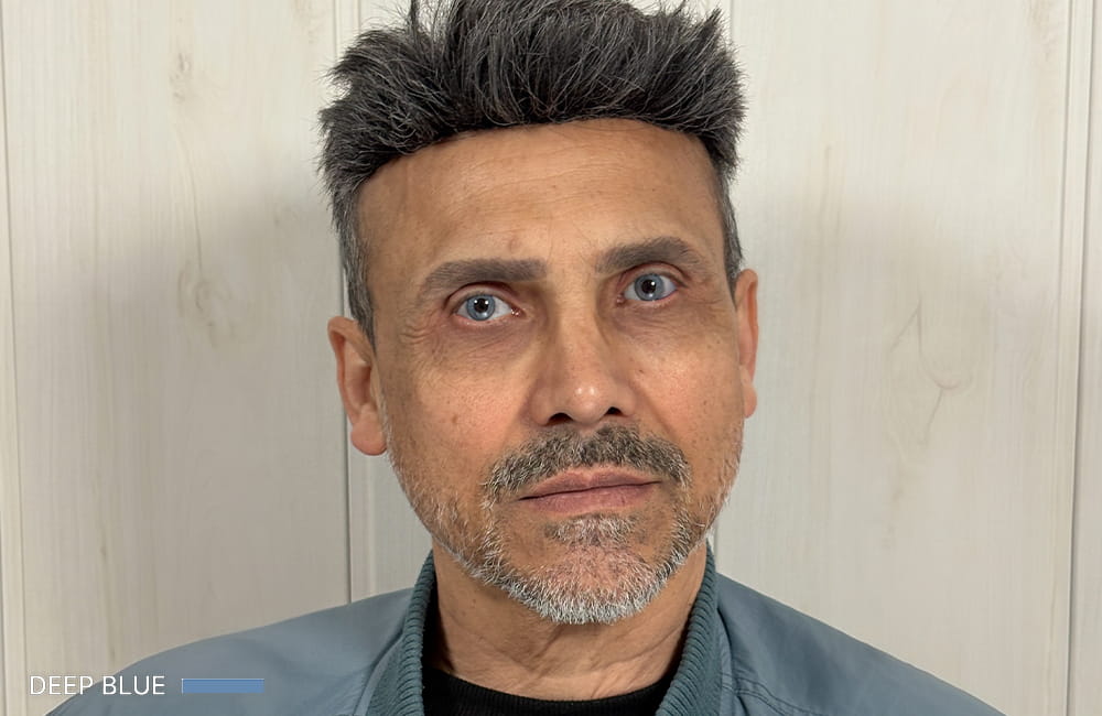 مريض إيراني بعيون زرقاء غامقة بعد تغيير لون العيون الدائم بزراعة الصباغ القرنية في مركز عيون كروماتيك الطبي