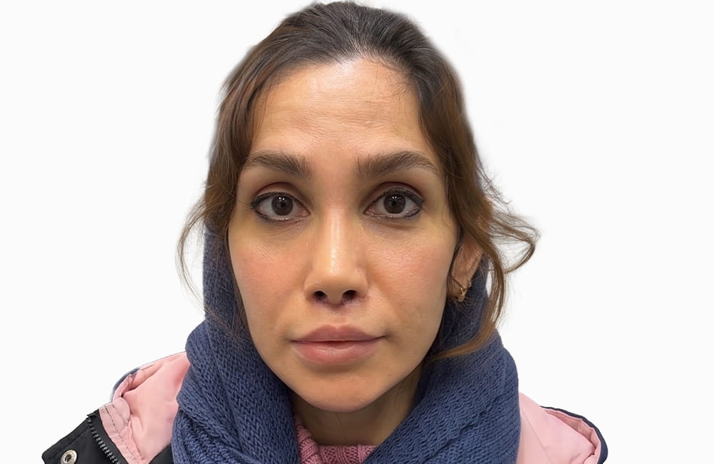 مريضة إيرانية بعيون بنية طبيعية قبل تغيير لون العيون بزراعة الصباغ القرنية في مركز عيون كروماتيك الطبي، ميدان ونك، طهران، إيران
