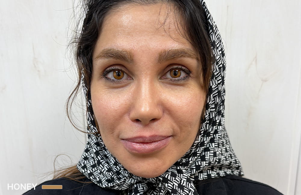 مريضة إيرانية بعيون عسلية بعد 4 أشهر من تغيير لون العيون الدائم بزراعة الصباغ القرنية في مركز عيون كروماتيك الطبي، ميدان ونك، طهران، إيران