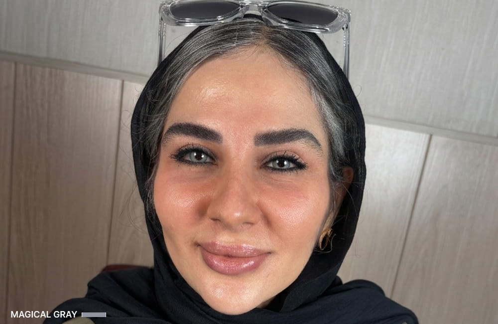 مريضة إيرانية بعيون رمادية سحرية بعد تغيير لون العيون الدائم بزراعة الصباغ القرنية في مركز عيون كروماتيك الطبي