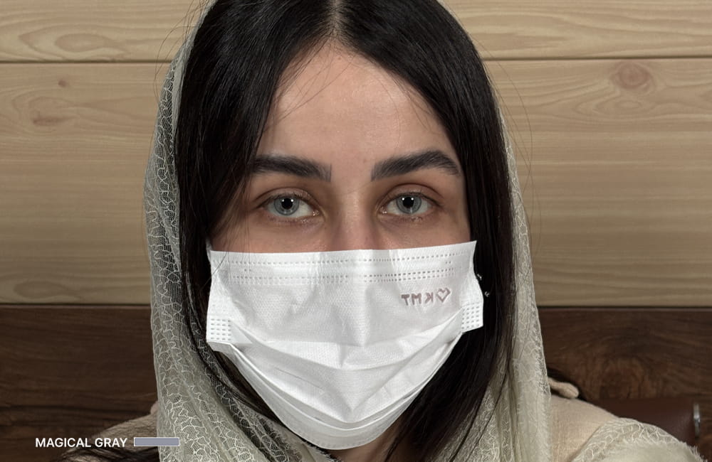 مريضة إيرانية بعيون رمادية سحرية بعد تغيير لون العيون الدائم بزراعة الصباغ القرنية في مركز عيون كروماتيك الطبي