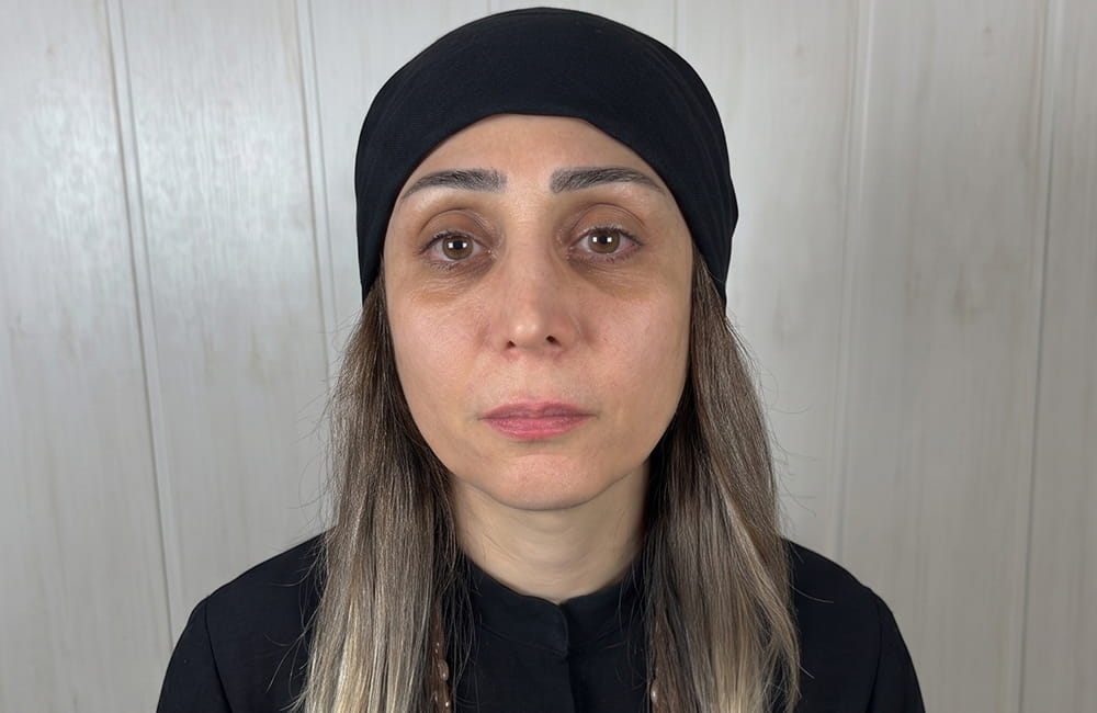 مريضة إيرانية بعيون بنية طبيعية قبل تغيير لون العيون بزراعة الصباغ القرنية في مركز عيون كروماتيك الطبي