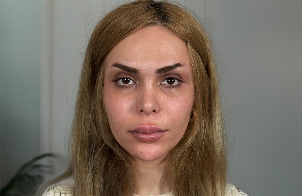 مريضة إيرانية بعيون بنية طبيعية قبل تغيير لون العيون بزراعة الصباغ القرنية في مركز عيون كروماتيك الطبي