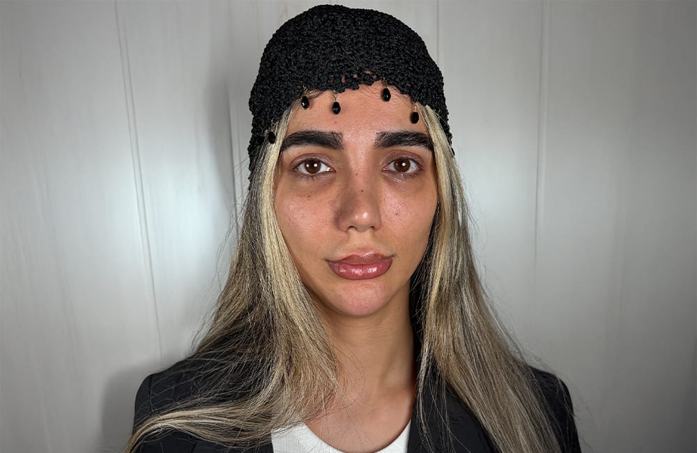 مريضة إيرانية بعيون بنية طبيعية قبل تغيير لون العيون بزراعة الصباغ القرنية في مركز عيون كروماتيك الطبي، ميدان ونك، طهران، إيران