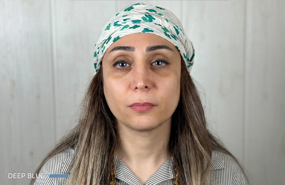 مريضة إيرانية بعيون زرقاء غامقة بعد تغيير لون العيون الدائم بزراعة الصباغ القرنية في مركز عيون كروماتيك الطبي