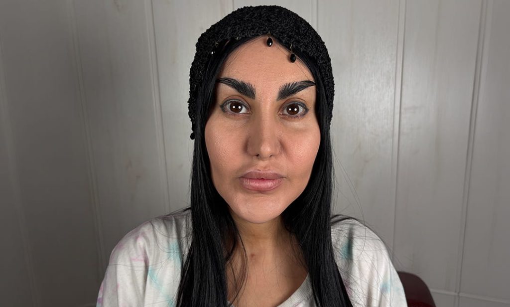 قزحية داكنة قبل الكيراتوبيغمنتيشن في عيادة Chromatic Eyes