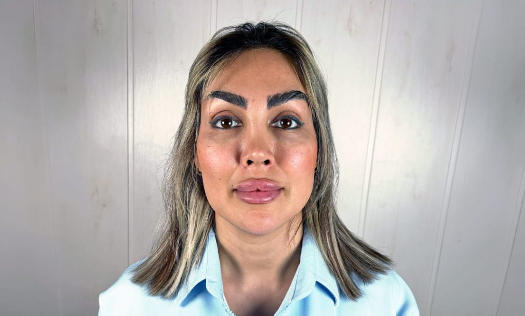قزحية بنية قبل الكيراتوبيغمنتيشن في عيادة Chromatic Eyes