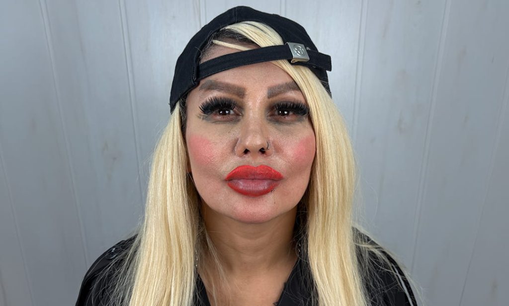 عين المريضة قبل الكيراتوبيغمنتيشن في عيادة Chromatic Eyes