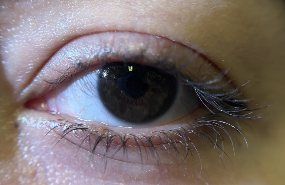 قزحية داكنة قبل بدء تفتيح لون العين بالليزر في Chromatic Eyes
