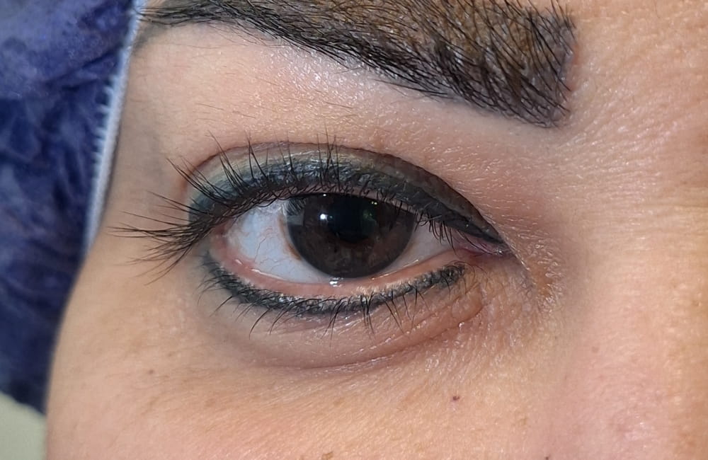 قزحية داكنة قبل تفتيح لون العين بالليزر في Chromatic Eyes