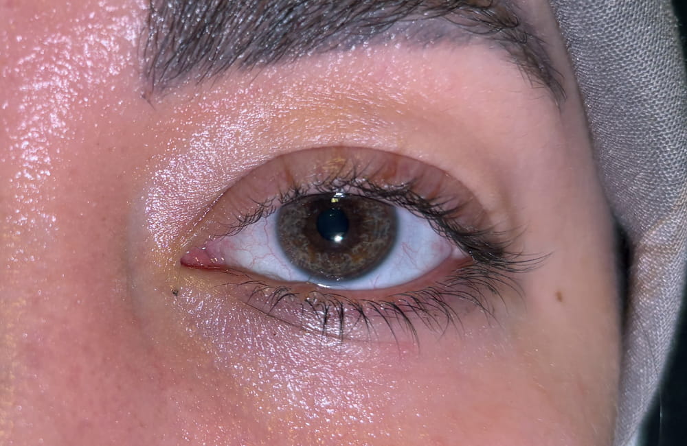 نتيجة اللون الذهبي العسلي بعد أربع جلسات تفتيح بالليزر في Chromatic Eyes