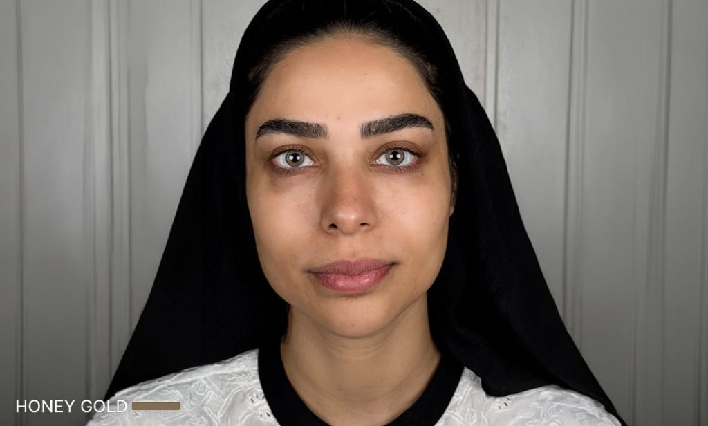عينا المريضة بلون ذهبي عسلي بعد الكيراتوبيغمنتيشن في Chromatic Eyes