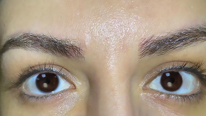 Laser Eye Color Change: A New Way to Customize Your Look