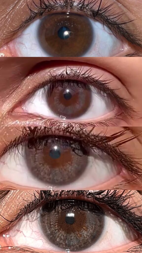 Results of eye color change with laser