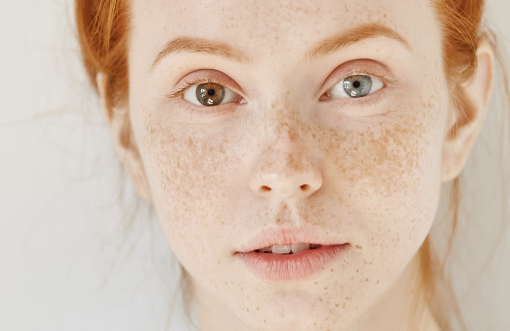 Heterochromia and eye color change