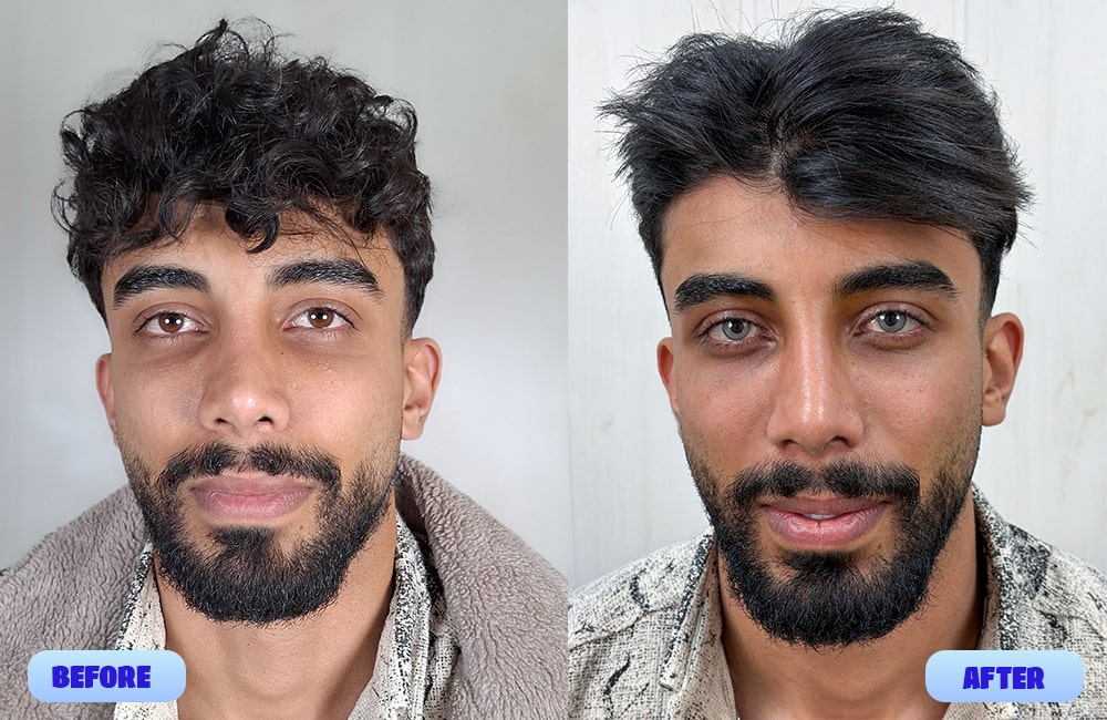 Keratopigmentation Before and After
