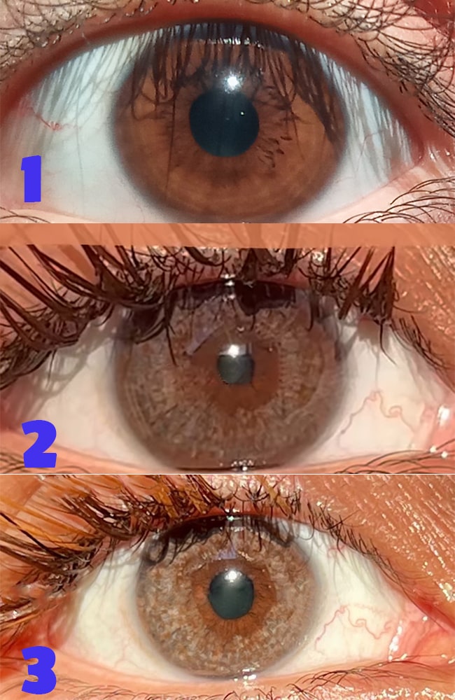 What to Expect During and After the Procedure?