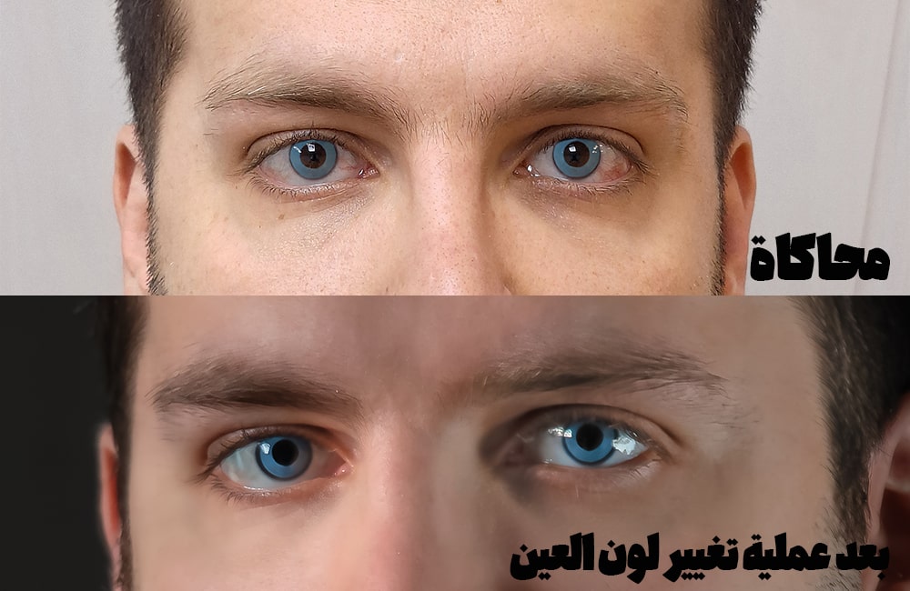 المحاكاة (السيموليشن) لتغيير لون العين