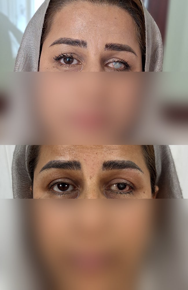 Real Cases: Eye Color Change Success