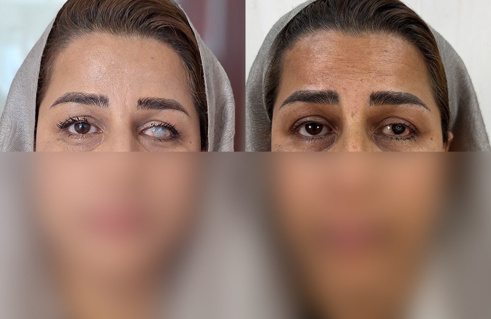 Real Cases: Eye Color Change Success