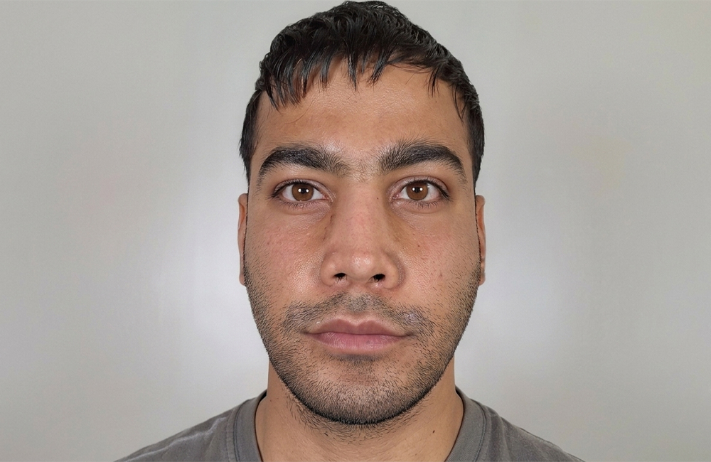Young Iranian male patient with natural brown eyes before French Blue eye color change by keratopigmentation at Chromatic Eyes Medical Center, Vanak Square, Tehran, Iran