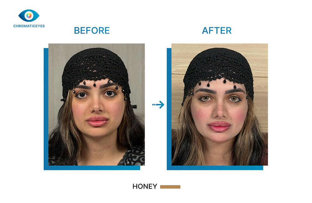 Honey eye color before and after keratopigmentation surgery - Chromatic Eyes