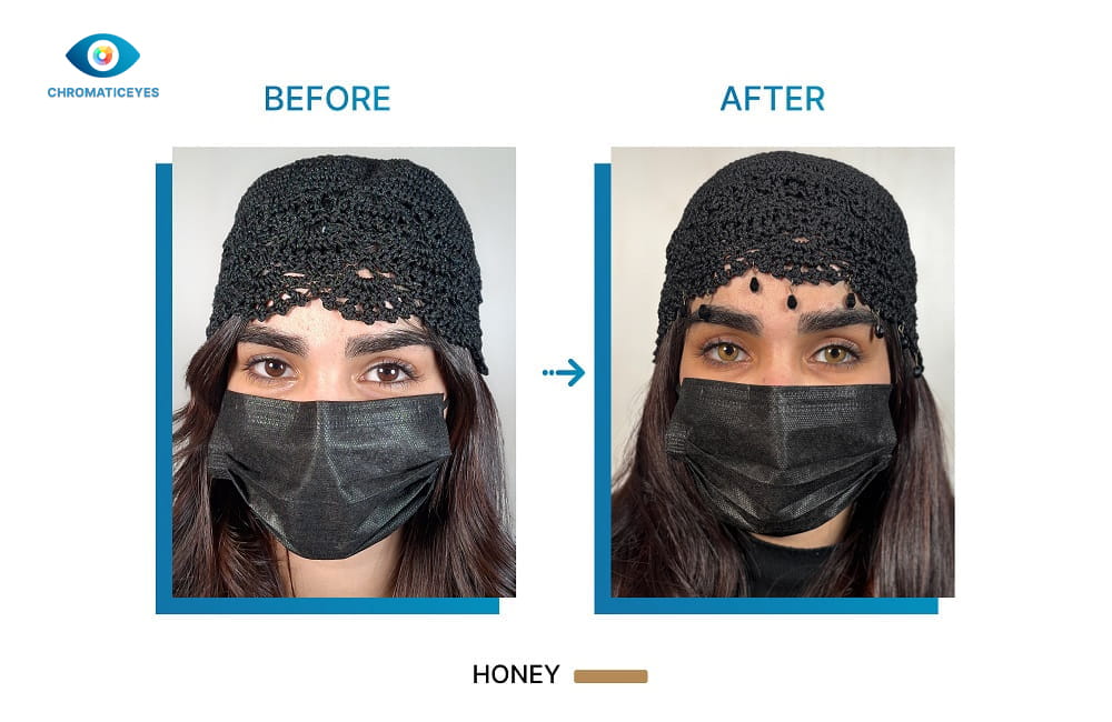 Honey eye color before and after keratopigmentation on dark hair warm skin - Chromatic Eyes