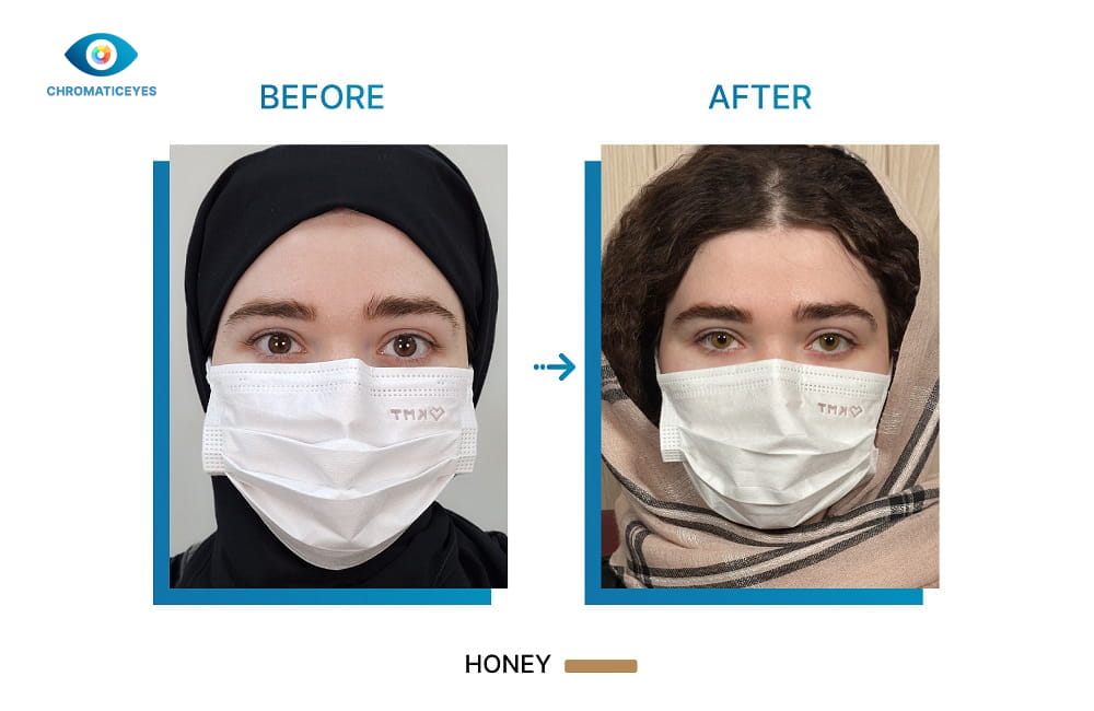 Honey eye color before and after keratopigmentation on fair skin - Chromatic Eyes