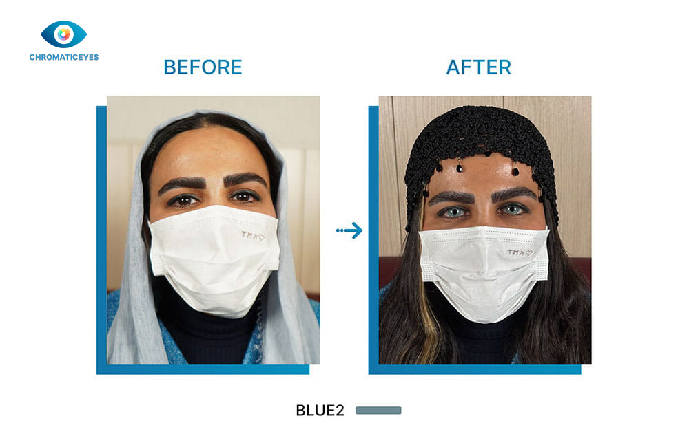 Before and after eye color change to Blue2 for dark hair female with keratopigmentation - Chromatic Eyes