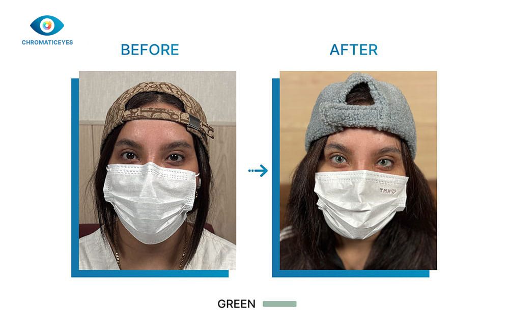 Before and after eye color change to green for dark hair female with keratopigmentation - Chromatic Eyes