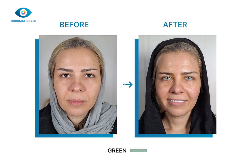 Before and after eye color change to green with keratopigmentation - Chromatic Eyes