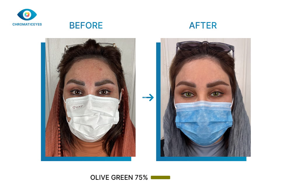 Before and after eye color change to olive green with keratopigmentation - Chromatic Eyes