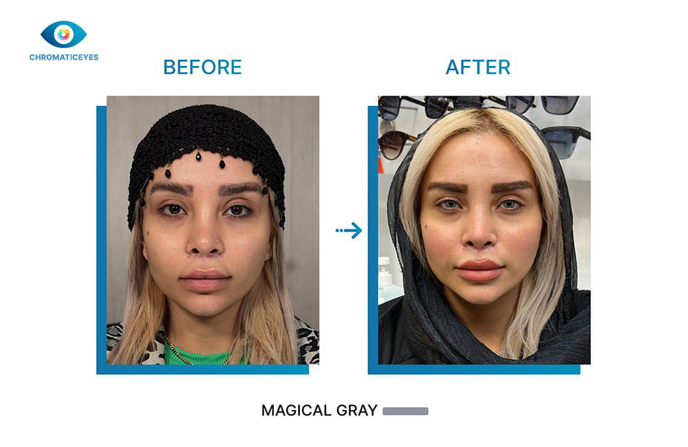Magical Gray eye color before and after keratopigmentation on blonde hair - Chromatic Eyes