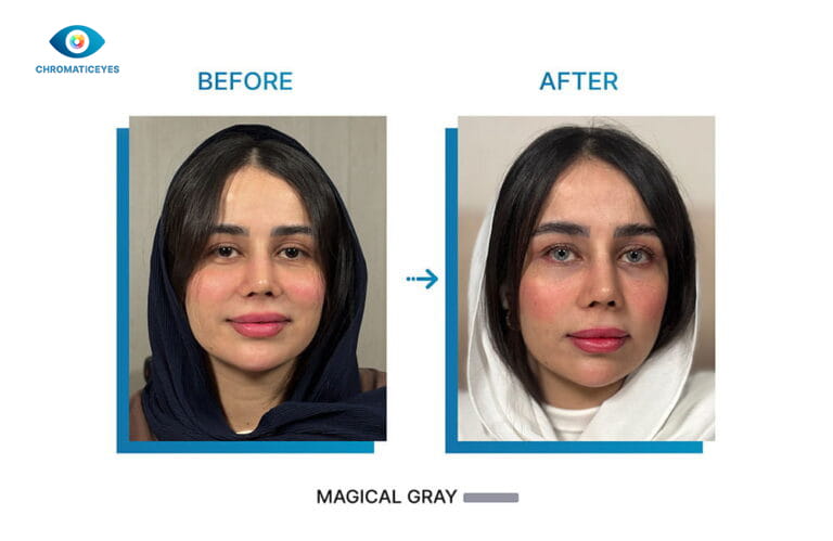 Magical Gray eye color before and after keratopigmentation on young dark hair patient - Chromatic Eyes