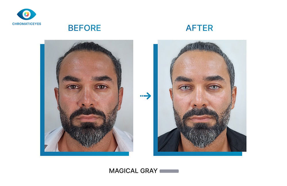 Magical Gray eye color before and after keratopigmentation on bearded man - Chromatic Eyes
