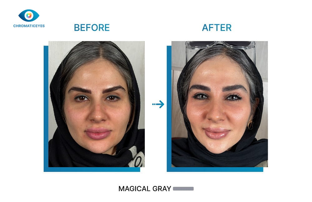 Magical Gray eye color before and after keratopigmentation on salt and pepper hair - Chromatic Eyes
