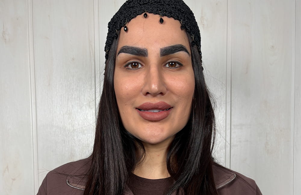 Iranian female patient with natural dark brown eyes before Magical Gray eye color change by keratopigmentation at Chromatic Eyes