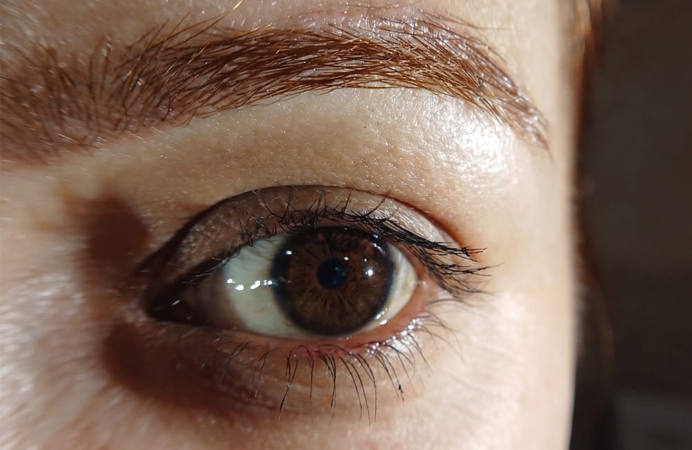 Female patient with natural dark brown eyes before laser iris depigmentation at Chromatic Eyes Medical Center, Vanak Square, Tehran, Iran
