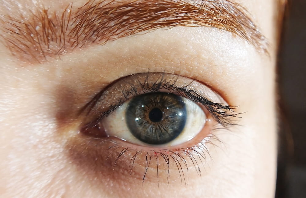 Female patient with blue-gray eyes and a warm brown central iris ring after three laser iris depigmentation sessions at Chromatic Eyes Medical Center, Tehran, Iran