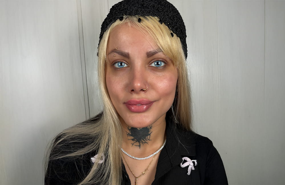 Female patient with natural-looking blue eyes after ETP eye color change procedure at Chromatic Eyes